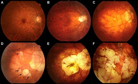 Hope for Myopic Macular Degeneration: Finding a Low Vision Optometrist